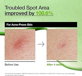 ANUA Azelaic Acid 10 Hyaluron Redness Soothing Serum- 30 ml